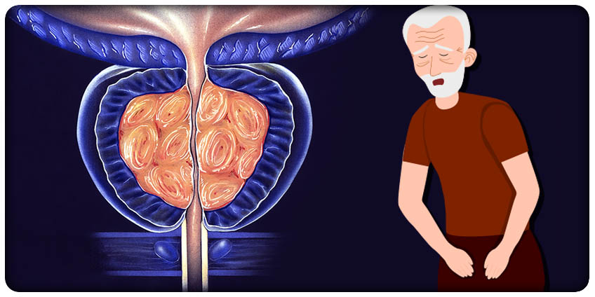 KÆMPER DU MED PROSTATAPROBLEMER?  Se, hvordan mænd som dig finder lindring